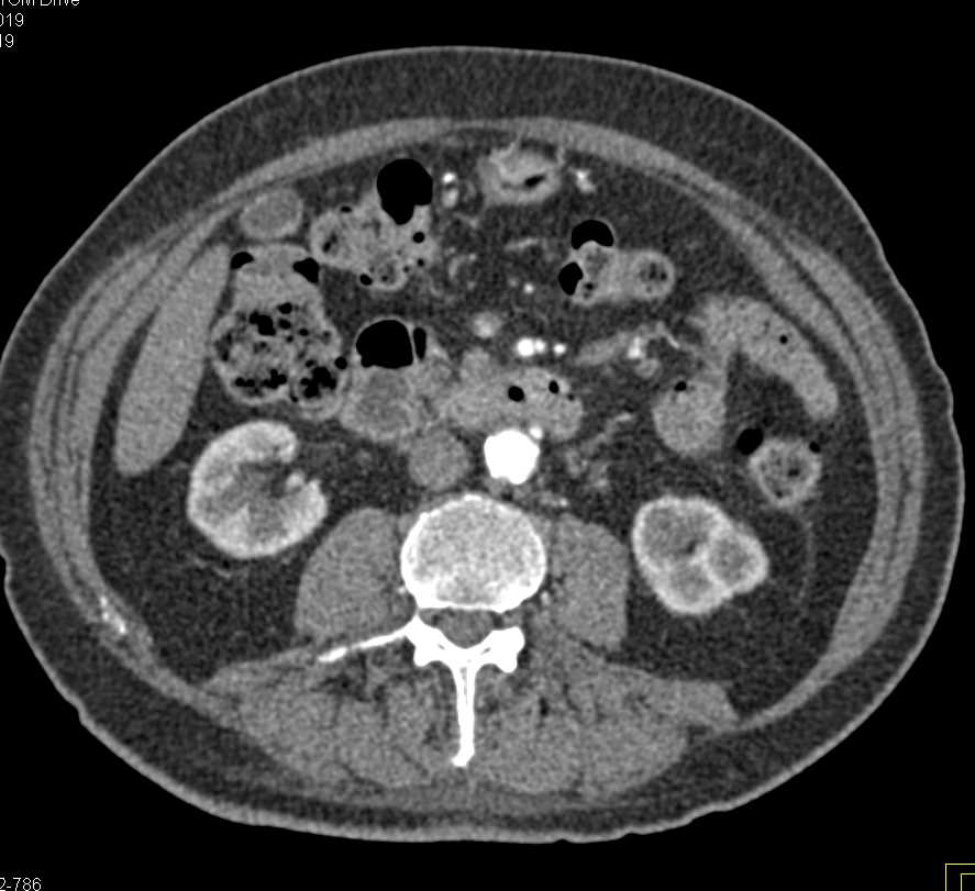 Adenocarcinoma 4th Portion Duodenum - CTisus CT Scan