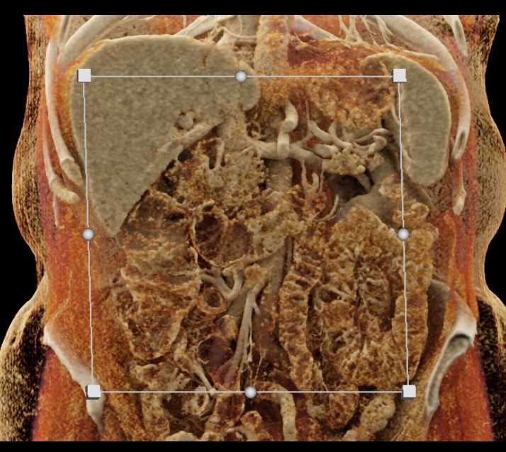 Adenocarcinoma 4th Portion Duodenum - CTisus CT Scan