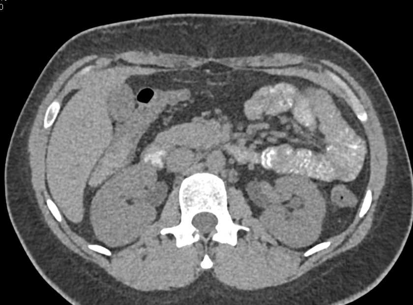 Jejunal Intussuception - CTisus CT Scan