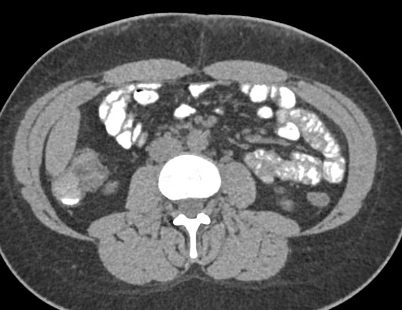 Jejunal Intussuception - Small Bowel Case Studies - CTisus CT Scanning