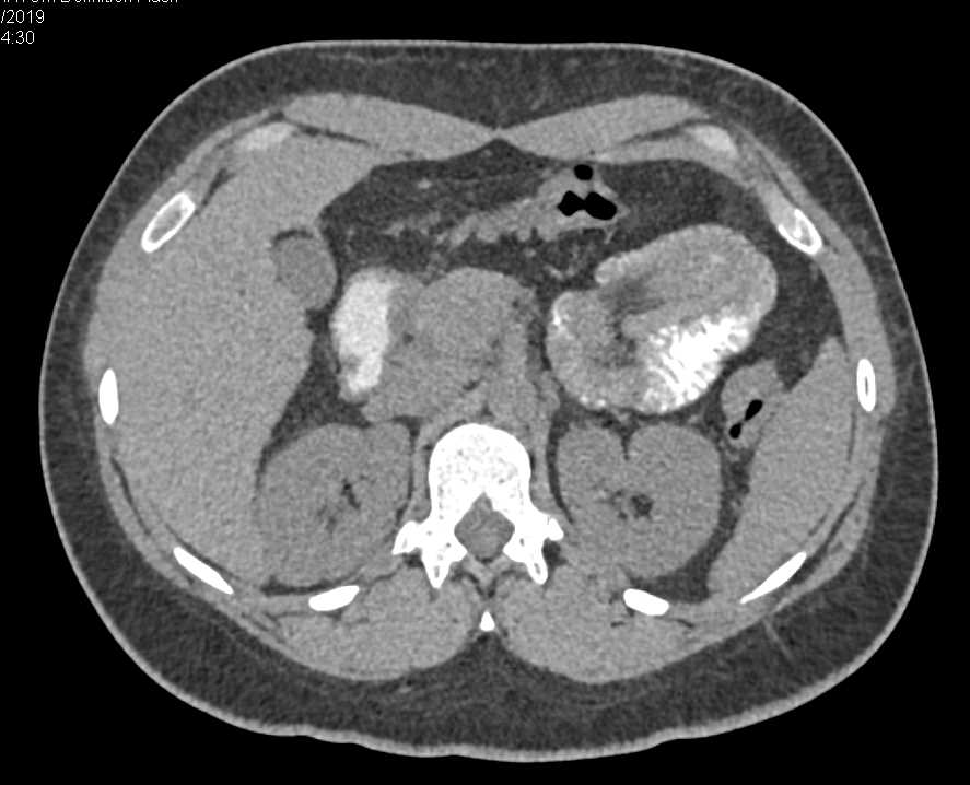 Jejunal Intussuception - CTisus CT Scan