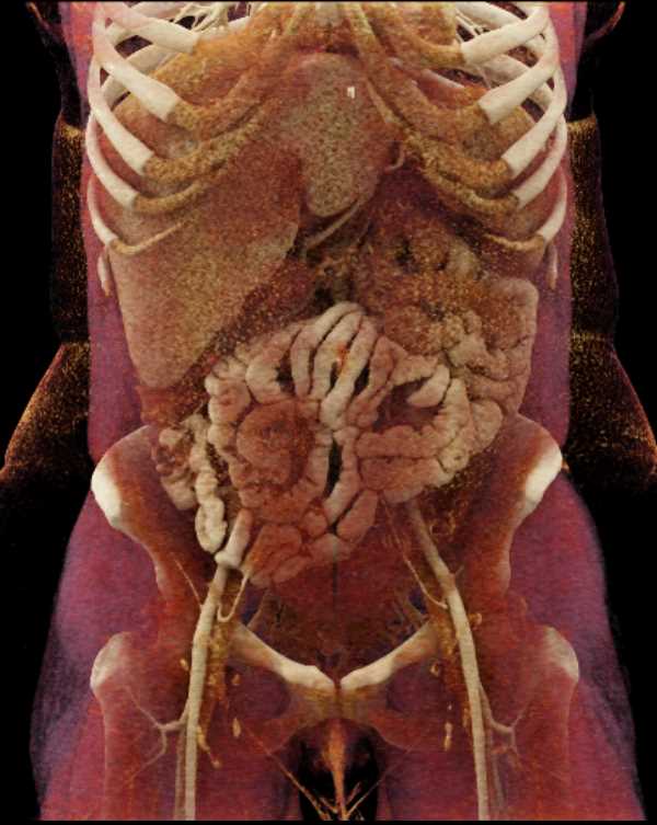 Jejunal Intussuception - CTisus CT Scan