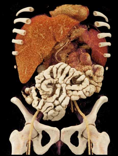 Jejunal Intussuception - CTisus CT Scan