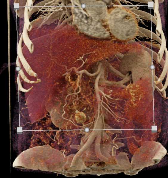 Carcinoid Tumor - CTisus CT Scan