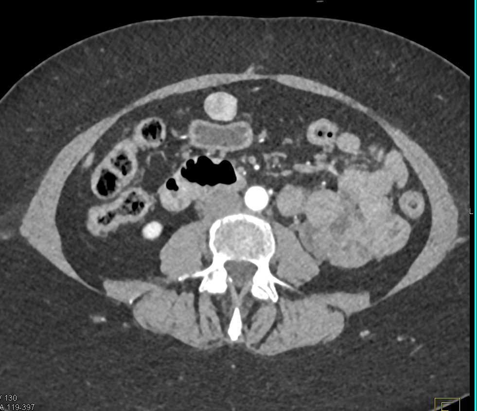 Carcinoid Tumor - CTisus CT Scan