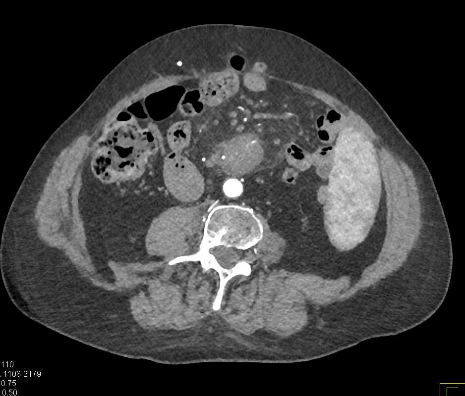 Carcinoid Tumor in the Root of the Mesentery - CTisus CT Scan