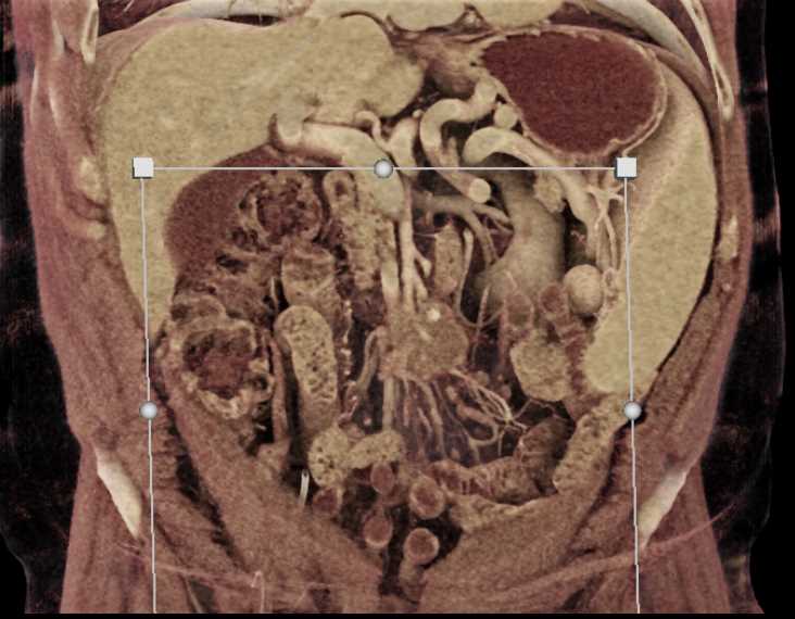 Carcinoid Tumor in the Root of the Mesentery - CTisus CT Scan