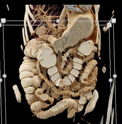 Cinematic Rendering with Positive Contrast and Crohns Disease - CTisus CT Scan