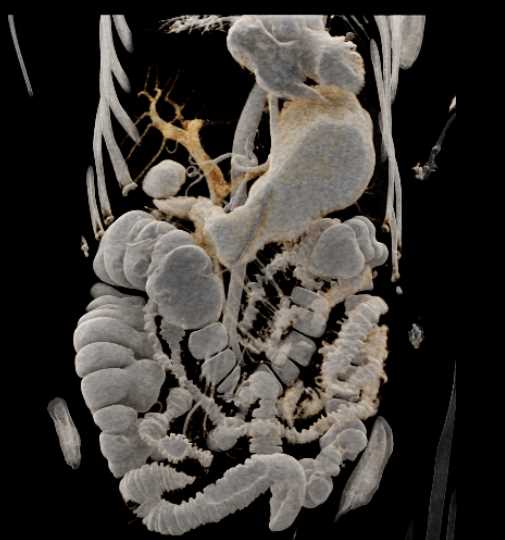 Cinematic Rendering with Positive Contrast and Crohn's Disease - CTisus CT Scan