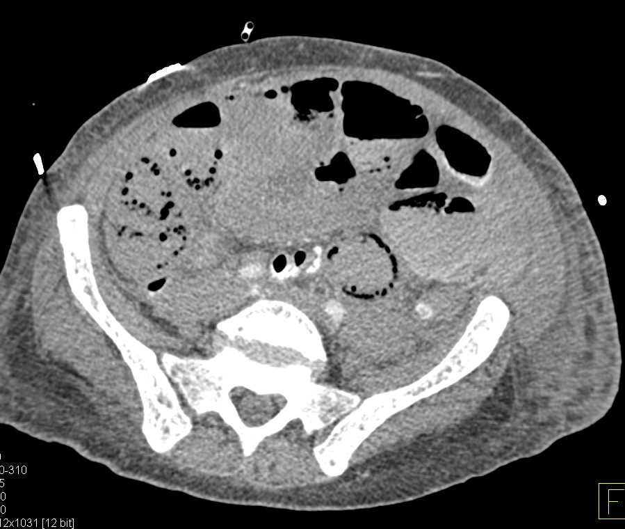 Ischemic Small Bowel with Pneumatosis - CTisus CT Scan