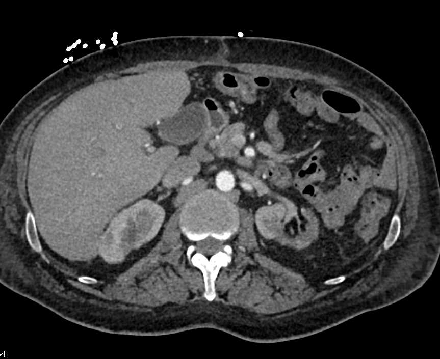 Small Bowel Ischemia - CTisus CT Scan