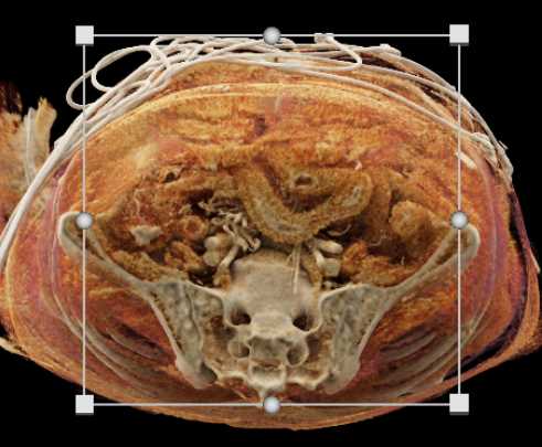 Small Bowel Ischemia - CTisus CT Scan