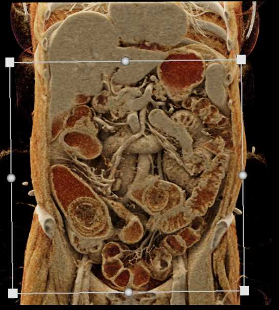 Intraluminal Mass with Intusuception RLQ - CTisus CT Scan