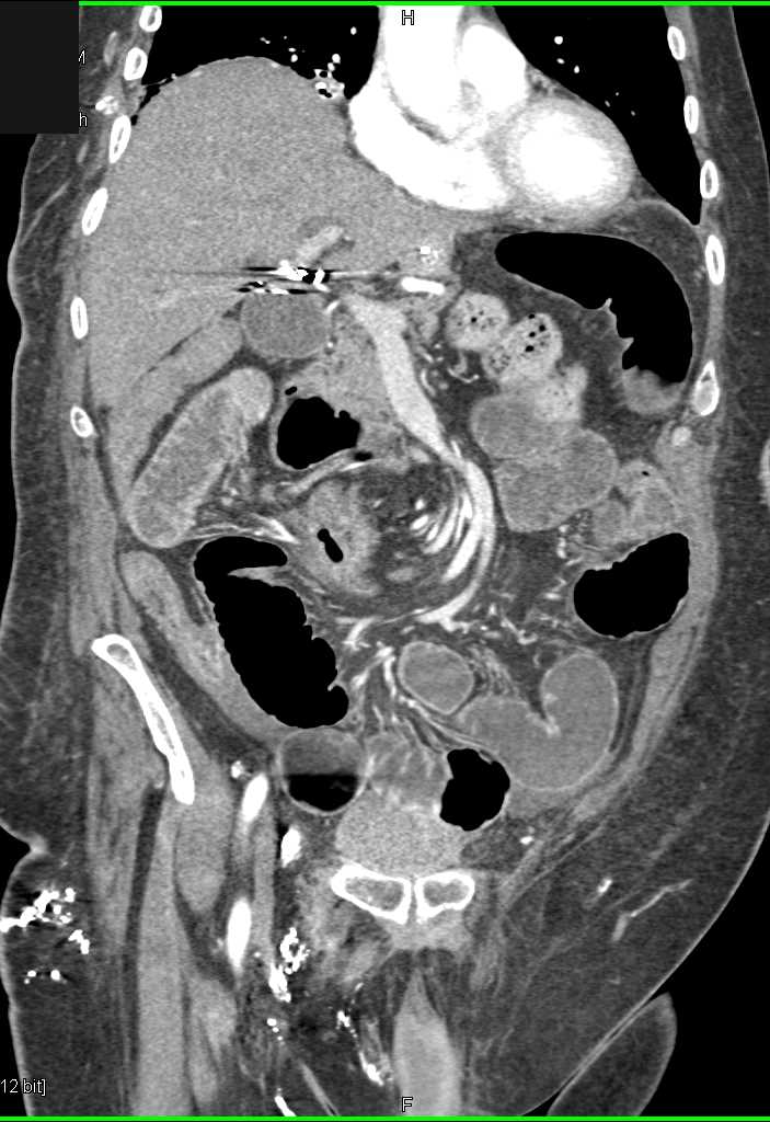 Midgut Volvulus - CTisus CT Scan