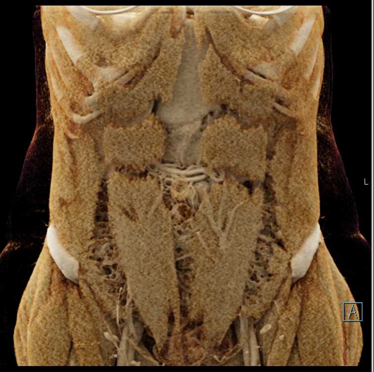 Mesenteric Cyst - CTisus CT Scan