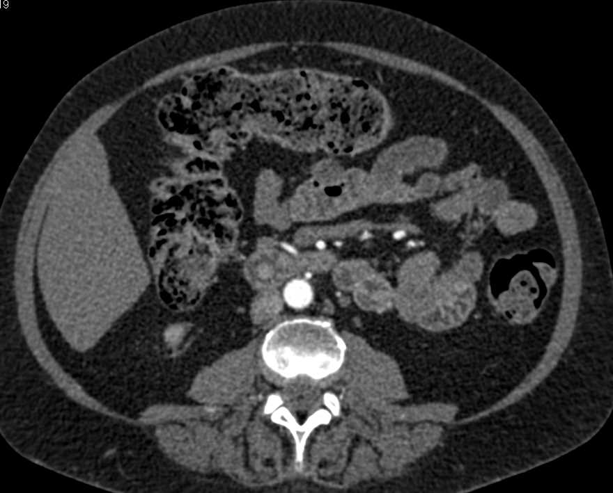 Active Bleed in the Duodenum - CTisus CT Scan