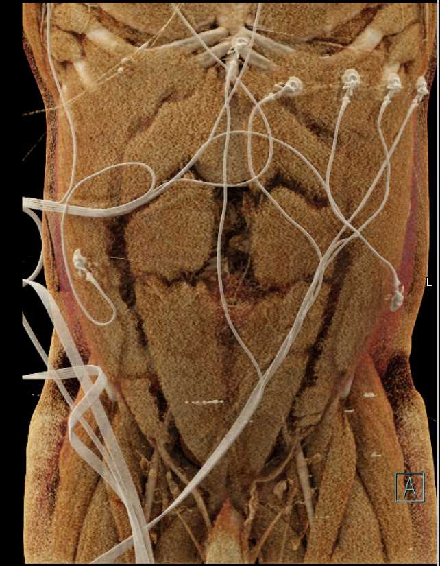 Mesenteric Lymphoma - CTisus CT Scan