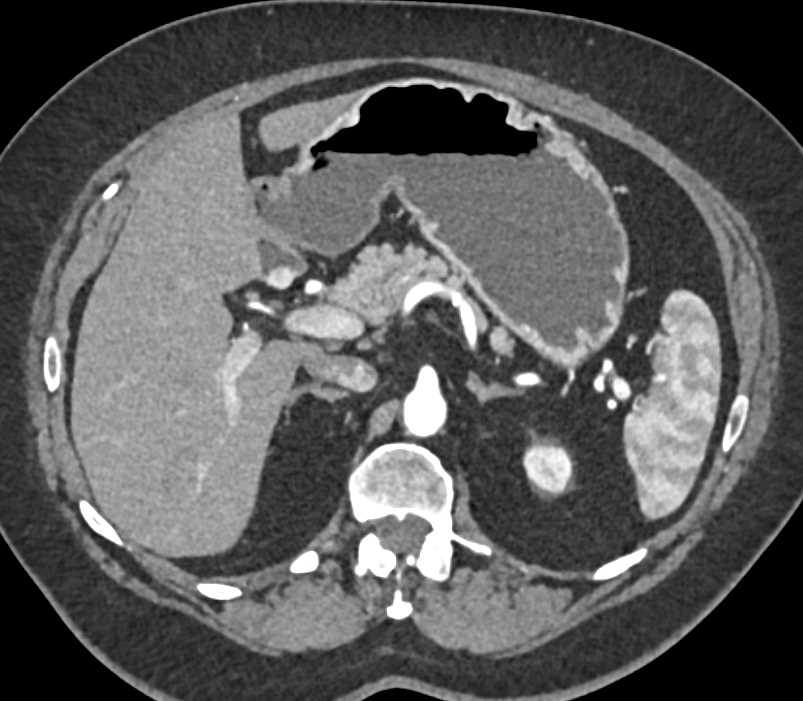 Duodenal Carcinoid Tumor - CTisus CT Scan