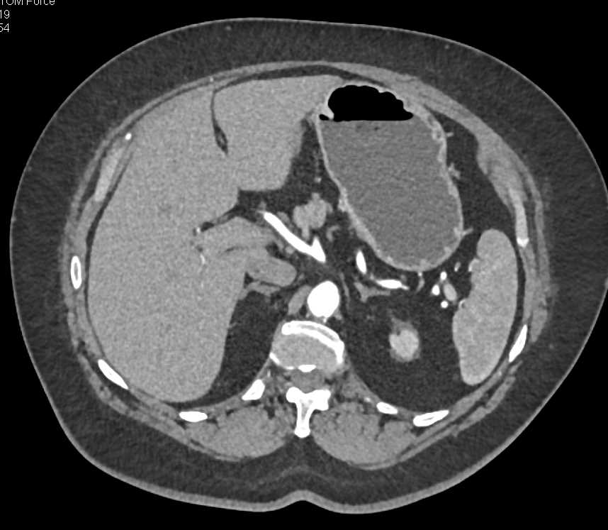 Neuroendocrine tumor in Duodenum - CTisus CT Scan