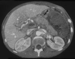 Portal Vein Thrombosis and Infarcted Spleen - CTisus CT Scan