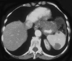 Metastases to the Spleen - CTisus CT Scan