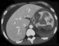 Splenic Laceration With Hemoperitoneum - CTisus CT Scan