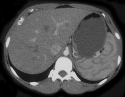 Moire Spleen - CTisus CT Scan