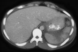 Splenic Infarcts - CTisus CT Scan