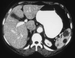 Splenic Hemangioma - CTisus CT Scan