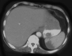 Splenic Infarcts - CTisus CT Scan