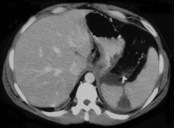 Splenic Laceration S/P Laparoscopic Nissan Procedure - CTisus CT Scan