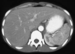 Mai Spleen - CTisus CT Scan