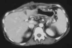 Splenic Vein Occlusion With Collaterals - CTisus CT Scan