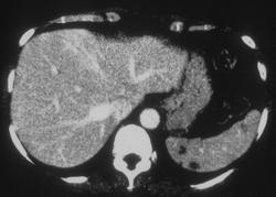 Splenic Hemangioma - CTisus CT Scan