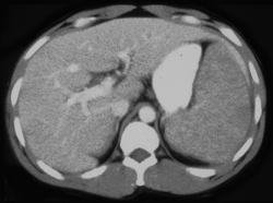 Splenic Lymphoma - CTisus CT Scan