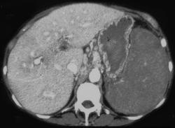 Chronic Lymphocytic Leukemia (CLL) Spleen - CTisus CT Scan