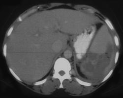 Splenic Abscess - CTisus CT Scan