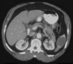 Splenic Cyst - CTisus CT Scan