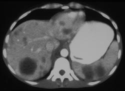 Ovarian Cancer With Splenic and Liver Metastases - CTisus CT Scan