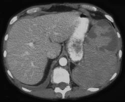 Splenic Infarcts - CTisus CT Scan