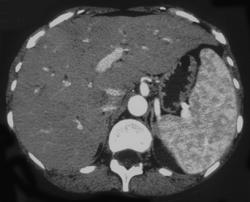 Normal Spleen - CTisus CT Scan