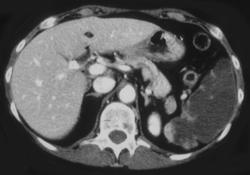 Splenic Infarcts in Patient With Itp - CTisus CT Scan