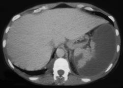 Splenic Infarction - CTisus CT Scan