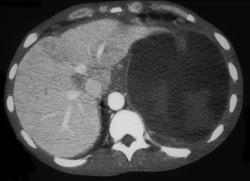 Bleed in Splenic Bed - CTisus CT Scan