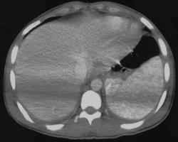 Sickle Cell Disease - CTisus CT Scan