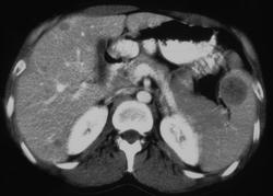 Melanoma Metastatic to the Spleen - CTisus CT Scan