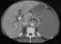 Splenic Lymphoma - CTisus CT Scan