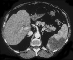 Splenic Infarction With Clot in Splenic Vein - CTisus CT Scan