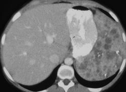 Splenic Hemangioma - CTisus CT Scan