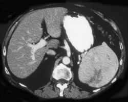 Splenic Hematoma - CTisus CT Scan